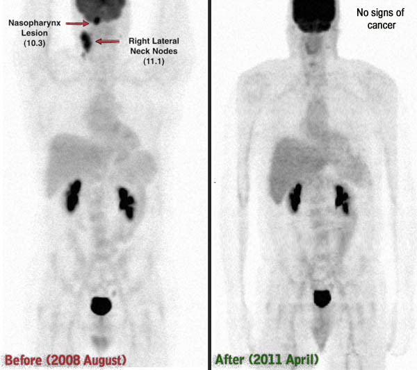 Non-Hodgkin Lymphoma I Before and After DCA treatment PET scan